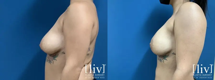 Breast Lift And Augmentation: Patient 2 - Before and After 3