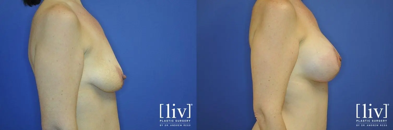 Breast Lift And Augmentation: Patient 7 - Before and After 3