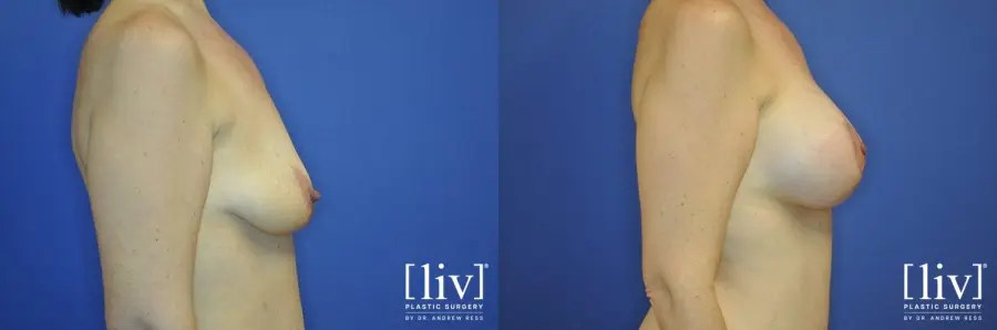 Breast Lift And Augmentation: Patient 7 - Before and After 3
