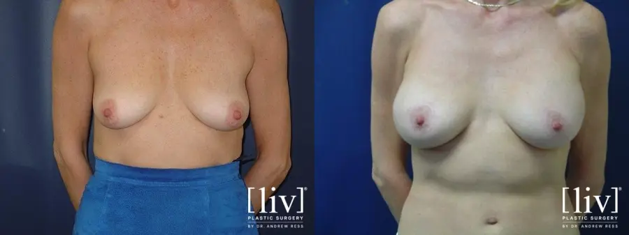 Breast Lift And Augmentation: Patient 10 - Before and After 1