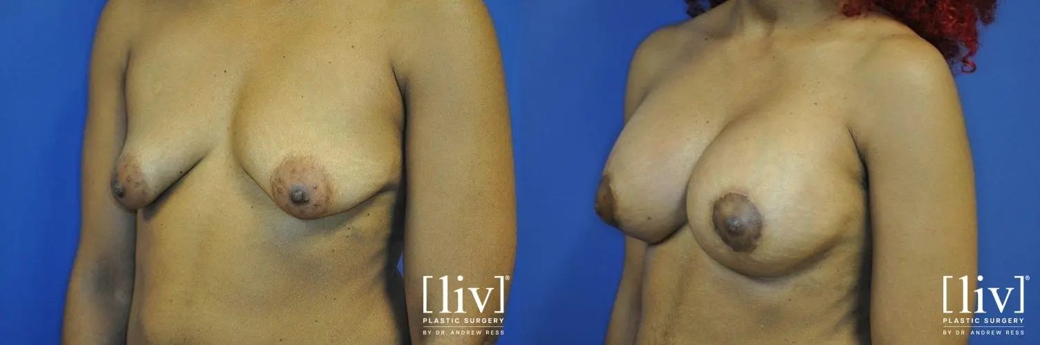 Breast Lift And Augmentation: Patient 11 - Before and After 2