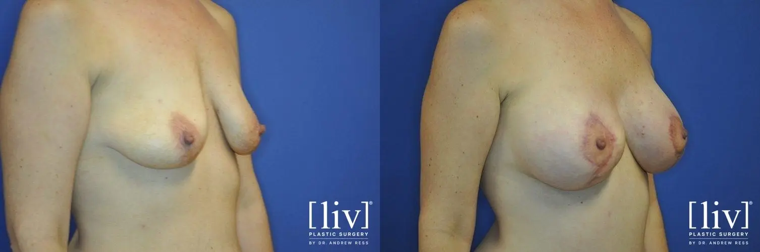 Breast Lift And Augmentation: Patient 7 - Before and After 2