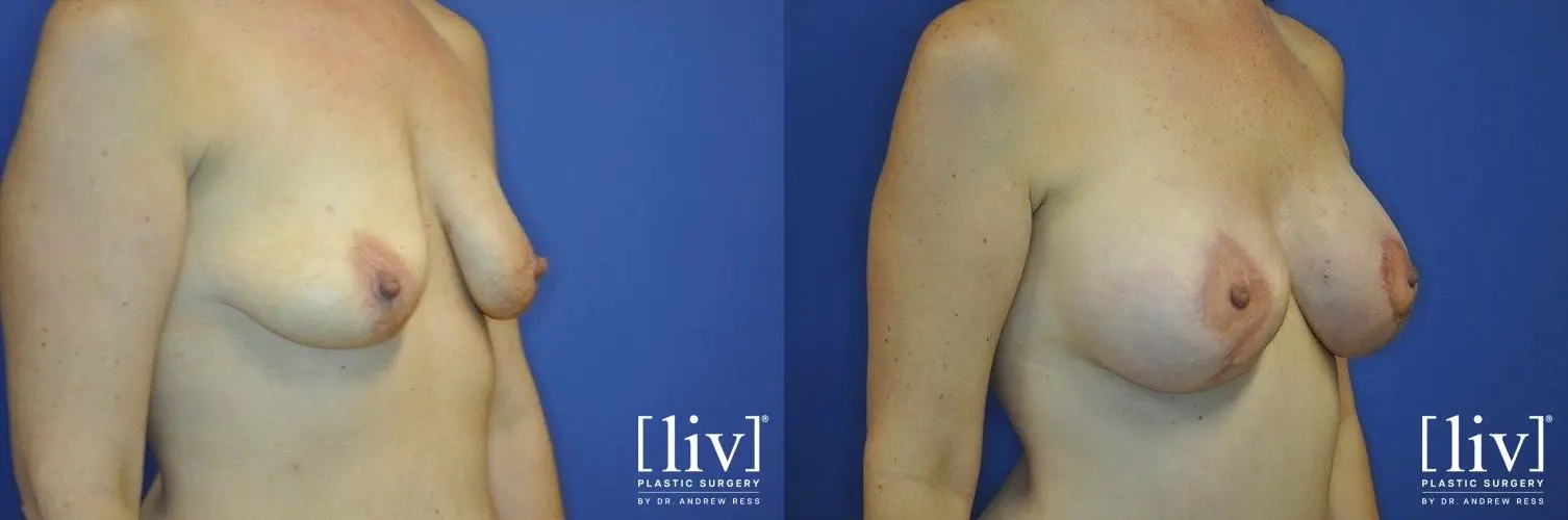 Breast Lift And Augmentation: Patient 4 - Before and After 2
