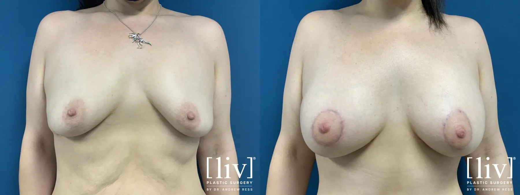 Breast Lift And Augmentation: Patient 15 - Before and After 1