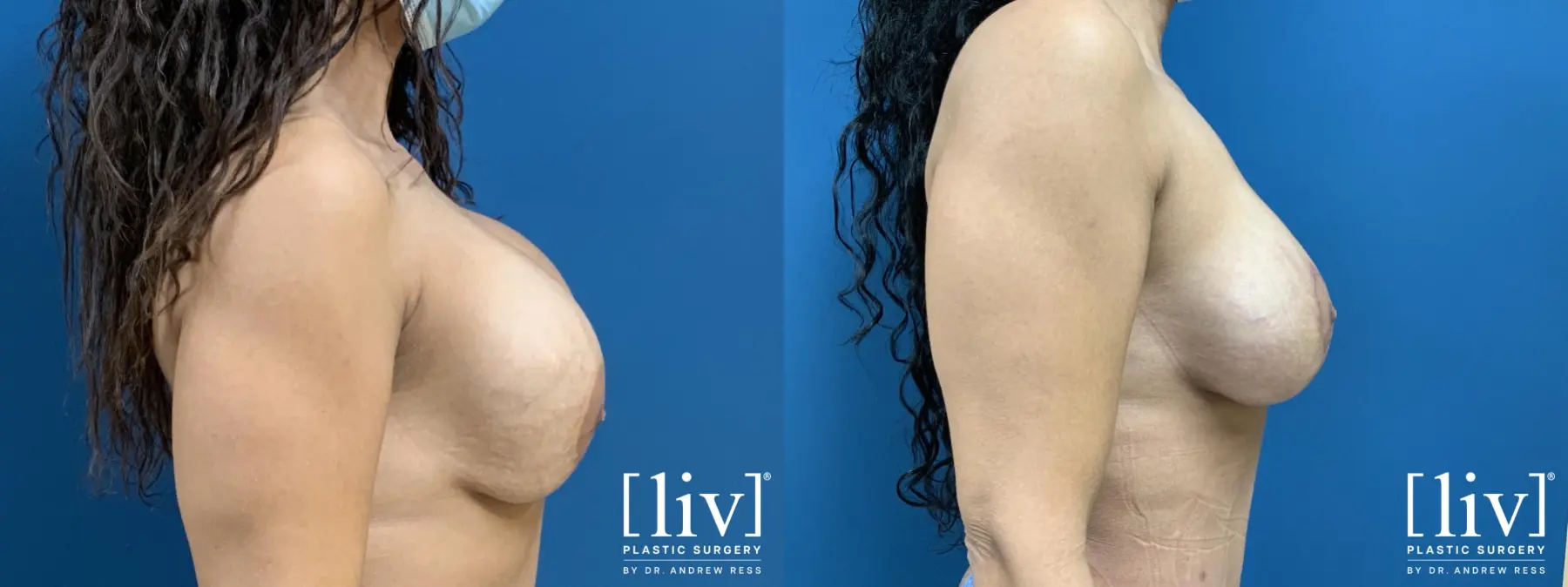 Breast Lift and Implant Exchange - Before and After 5