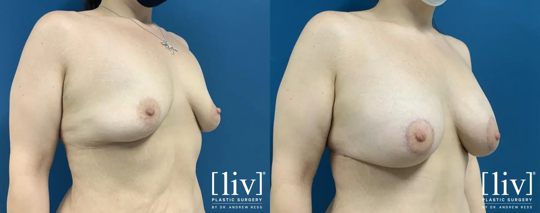 Breast Lift And Augmentation: Patient 15 - Before and After 4