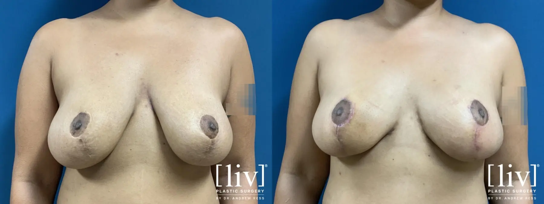 Breast Lift - Before and After 1