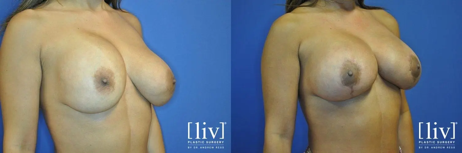 Breast Lift: Patient 11 - Before and After 2