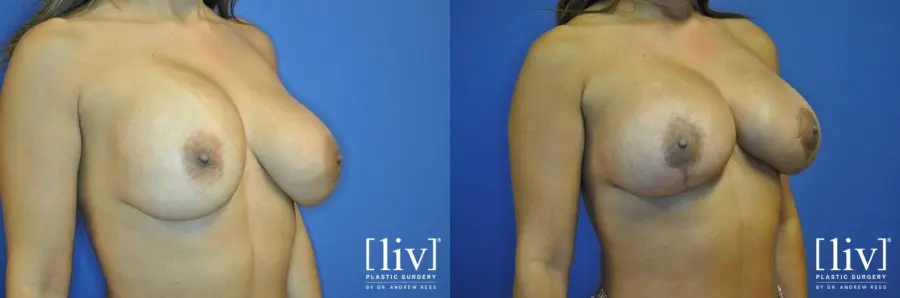 Breast Lift: Patient 10 - Before and After 2