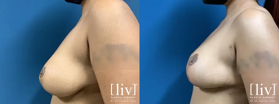 Breast Lift - Before and After 3