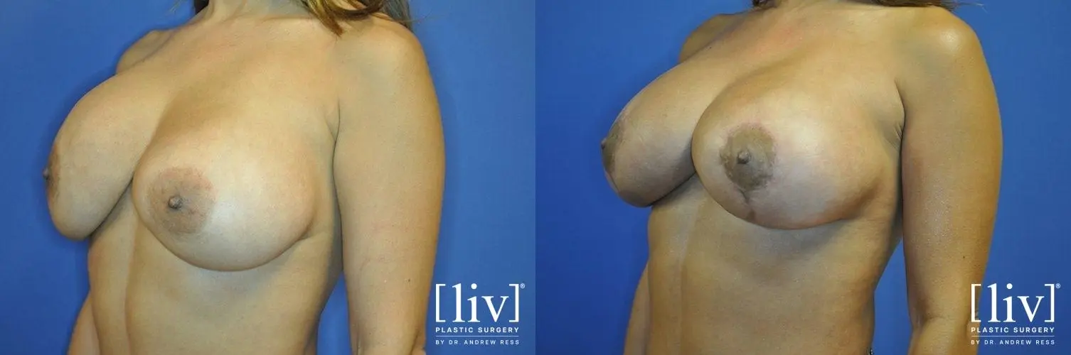 Breast Lift: Patient 11 - Before and After 4