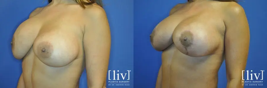 Breast Lift: Patient 10 - Before and After 4