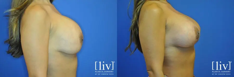 Breast Lift: Patient 10 - Before and After 3