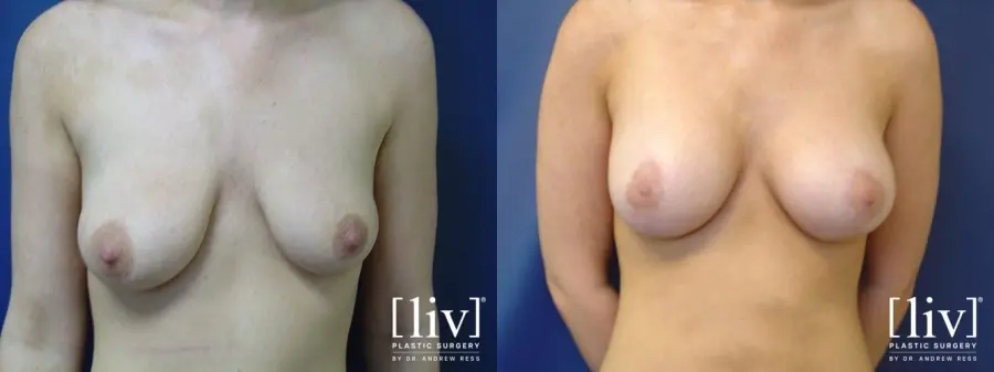 Breast Lift: Patient 4 - Before and After 1