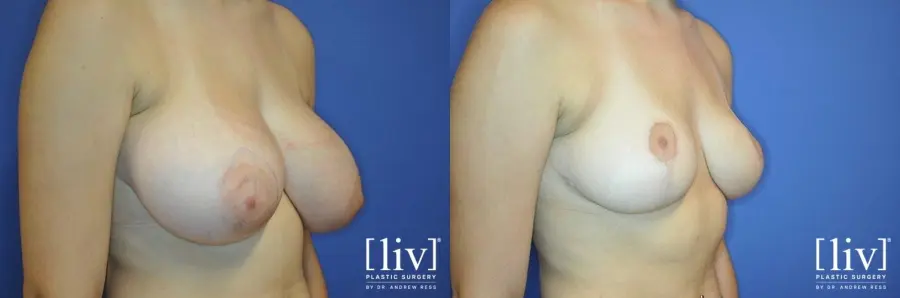 Breast Lift: Patient 2 - Before and After 2