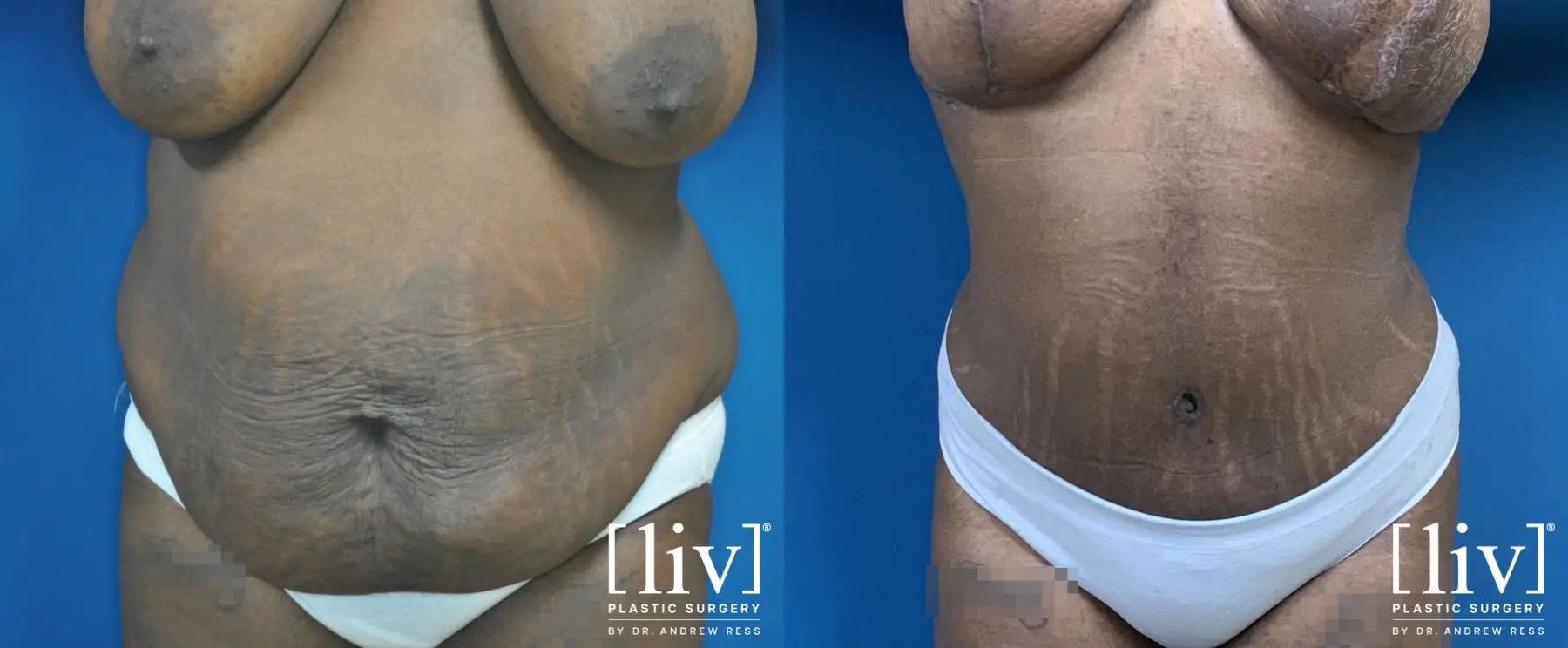 Breast Lift and Reduction - Before and After 2