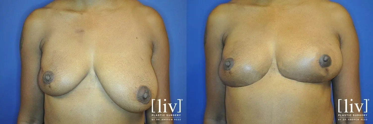 Breast Lift: Patient 10 - Before and After  