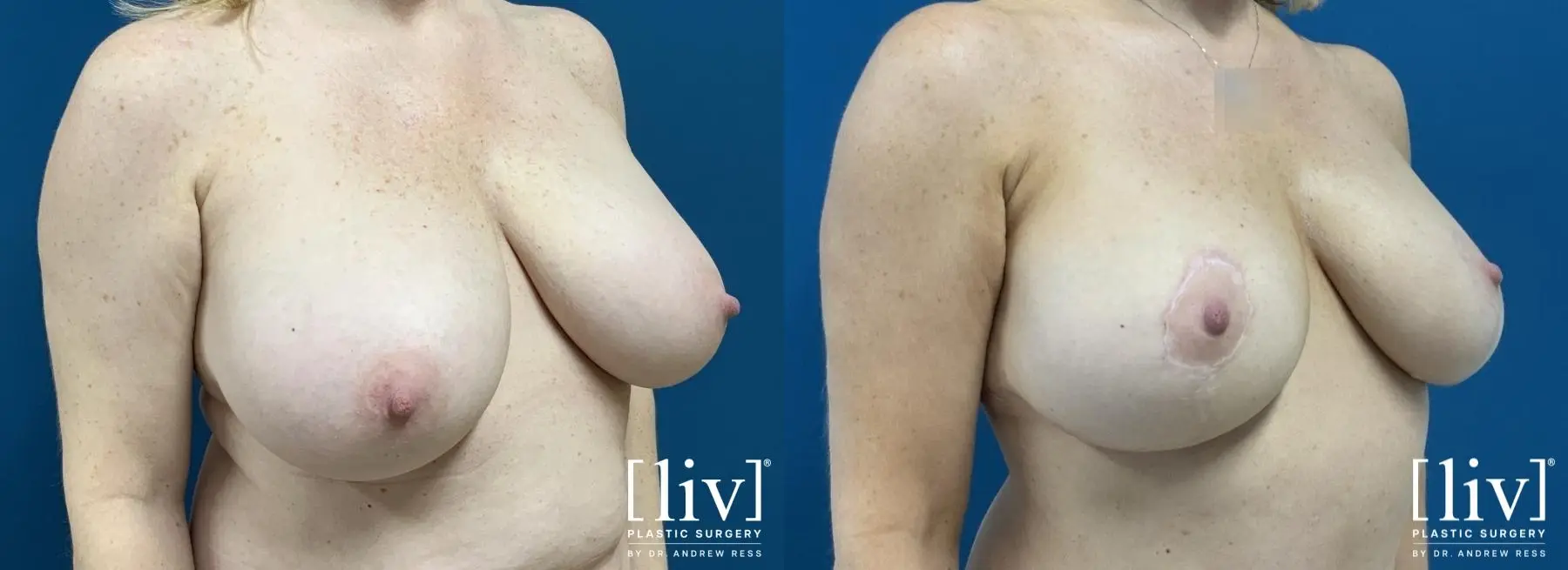 Breast Lift: Patient 1 - Before and After 2