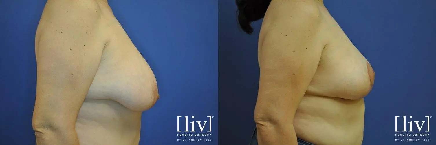 Breast Lift: Patient 8 - Before and After 3