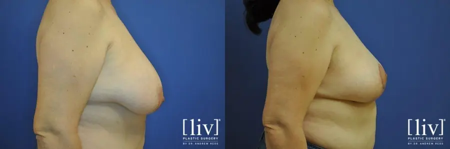 Breast Lift: Patient 7 - Before and After 3