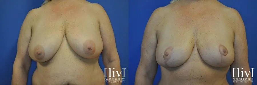 Breast Lift: Patient 8 - Before and After  