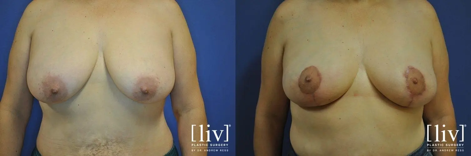 Breast Lift: Patient 8 - Before and After 1