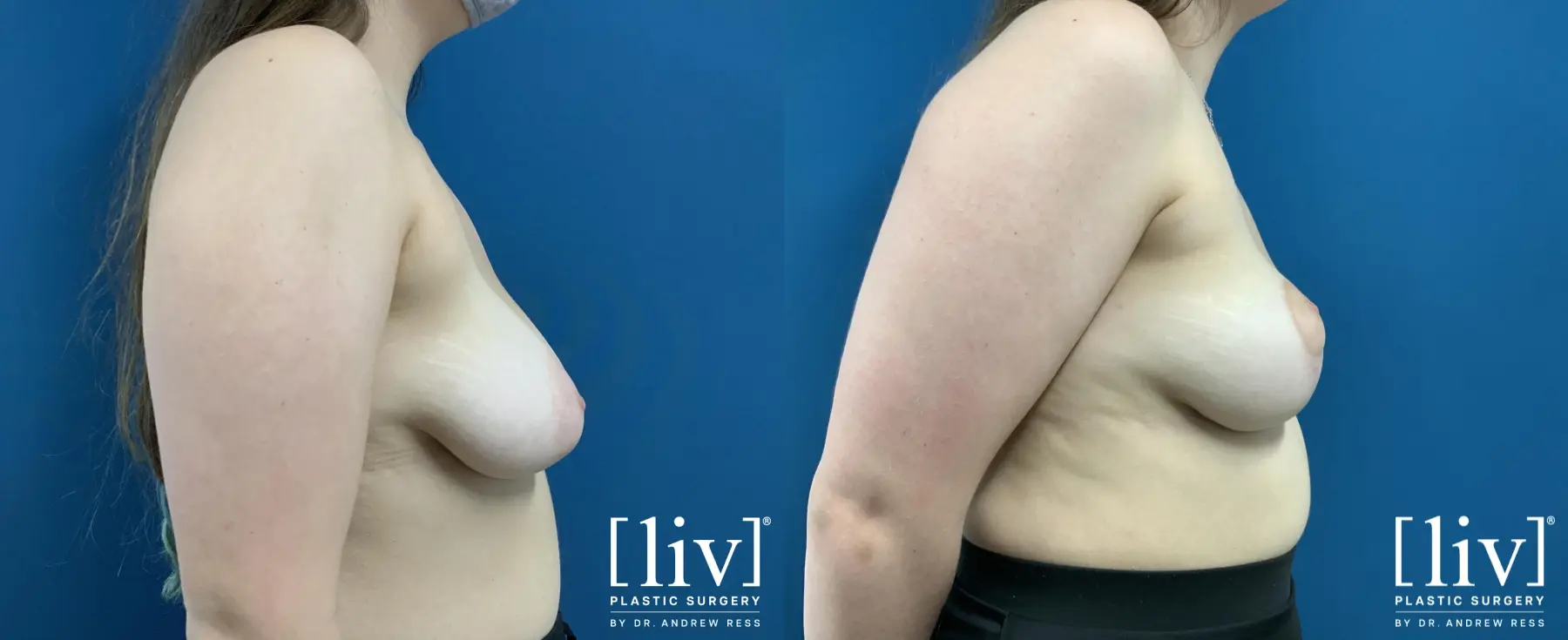 Breast Lift: Patient 3 - Before and After 5