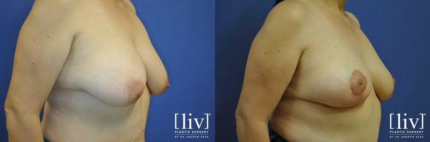 Breast Lift: Patient 8 - Before and After 2