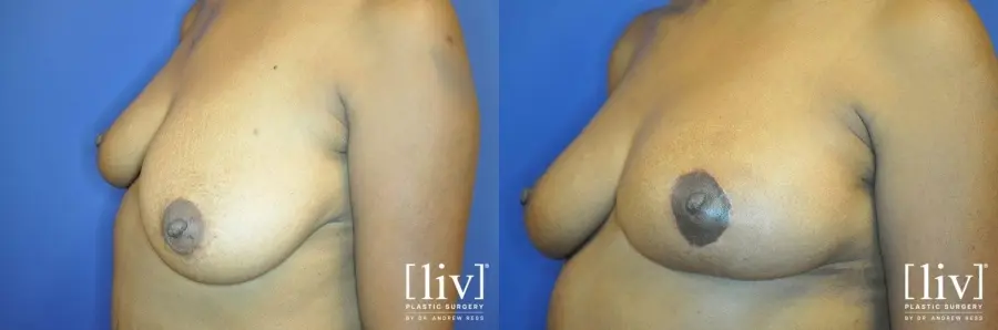 Breast Lift: Patient 9 - Before and After 2