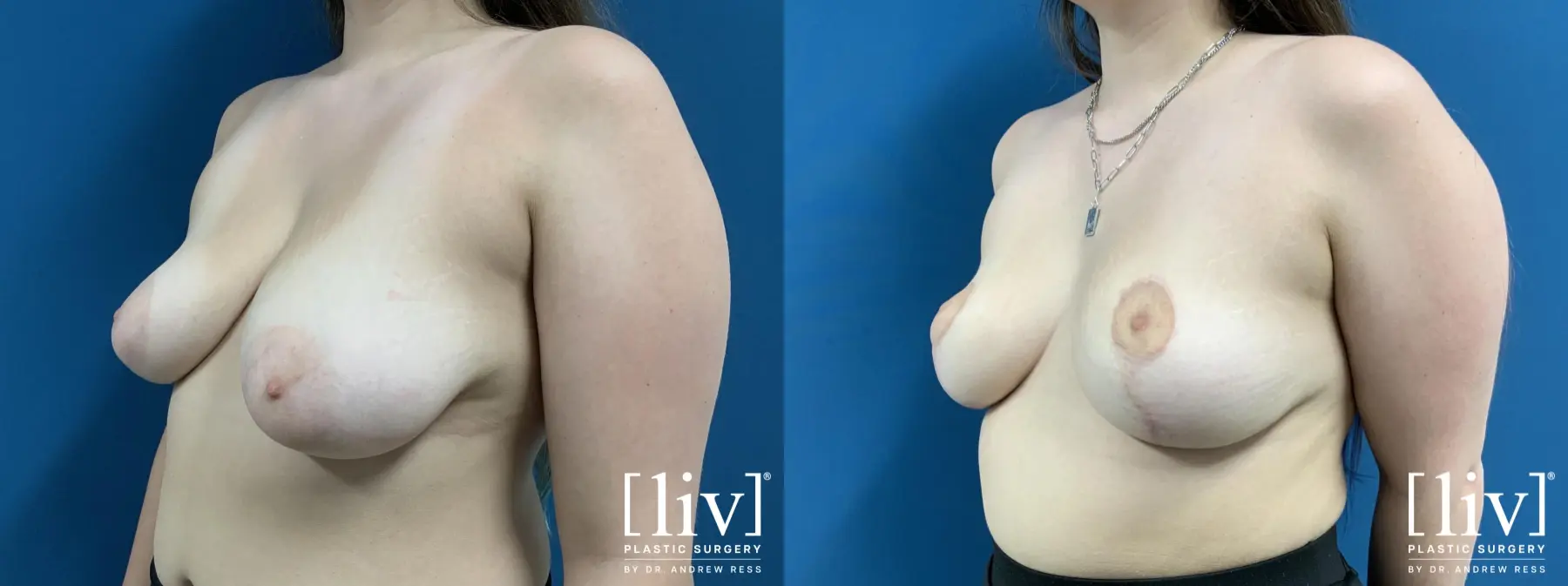 Breast Lift: Patient 3 - Before and After 2