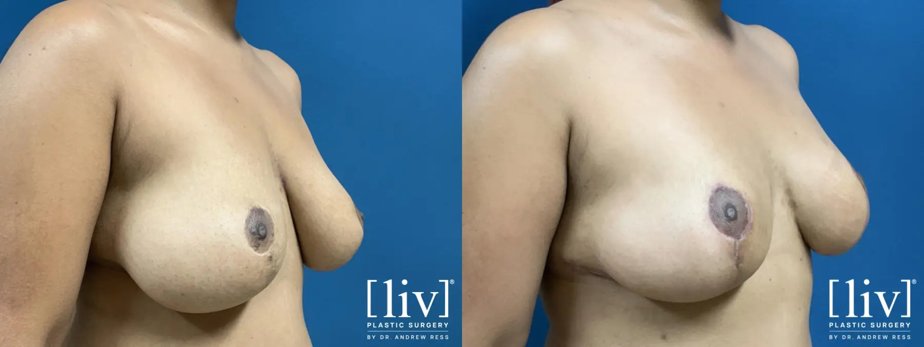 Breast Lift - Before and After 4