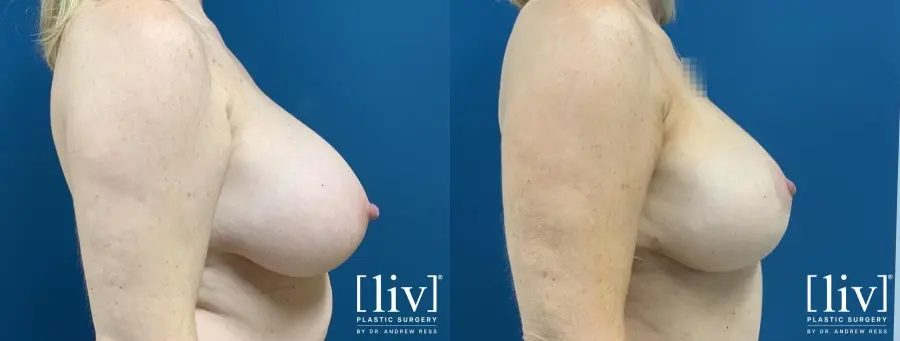 Breast Lift: Patient 1 - Before and After 3