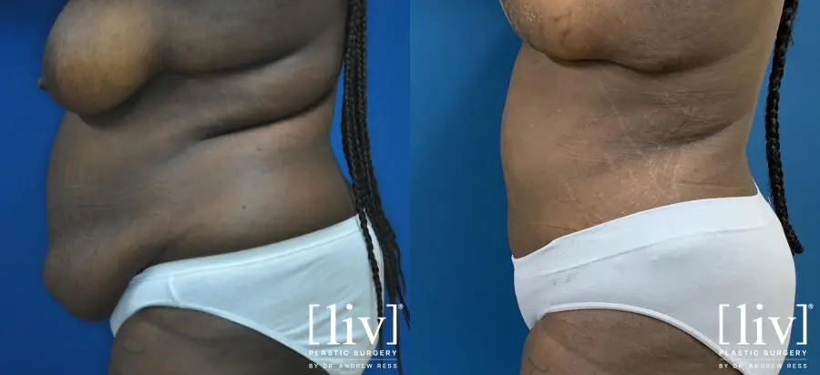 Breast Lift and Reduction - Before and After 3
