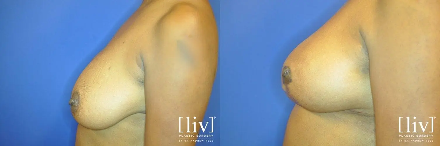 Breast Lift: Patient 10 - Before and After 3