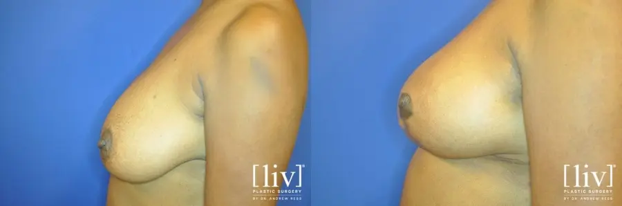 Breast Lift: Patient 9 - Before and After 3