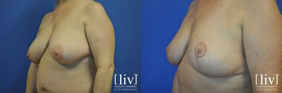 Breast Lift: Patient 8 - Before and After 2