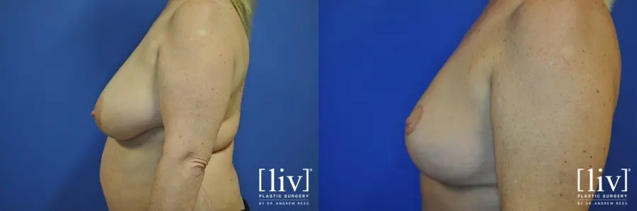 Breast Lift: Patient 8 - Before and After 3