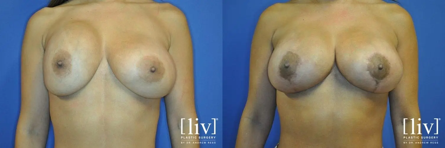 Breast Lift: Patient 11 - Before and After 1