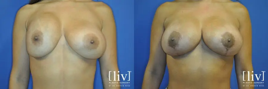 Breast Lift: Patient 10 - Before and After 1