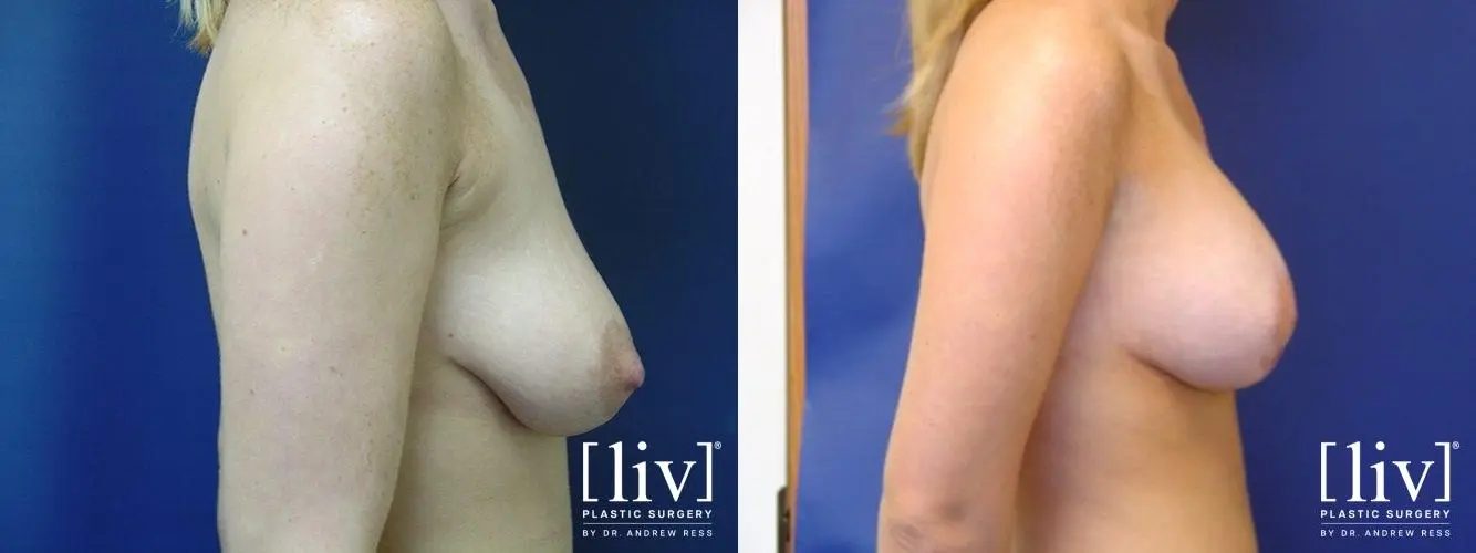 Breast Lift: Patient 5 - Before and After 2