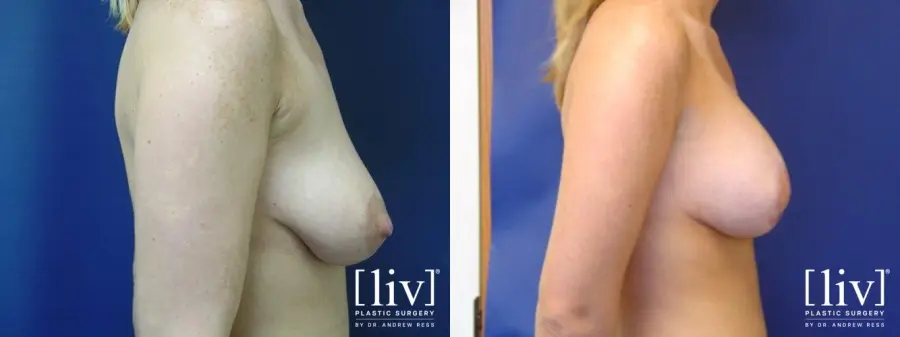 Breast Lift: Patient 4 - Before and After 2