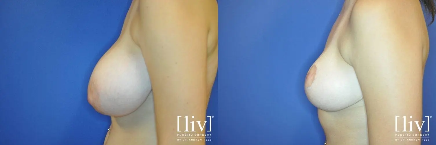 Breast Lift: Patient 2 - Before and After 3