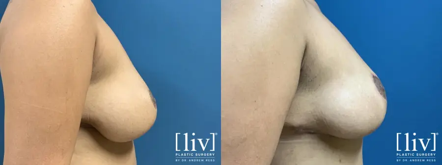 Breast Lift - Before and After 5