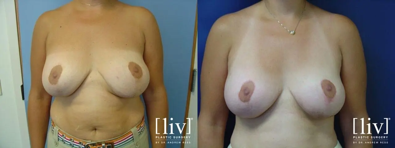 Breast Lift: Patient 4 - Before and After 1