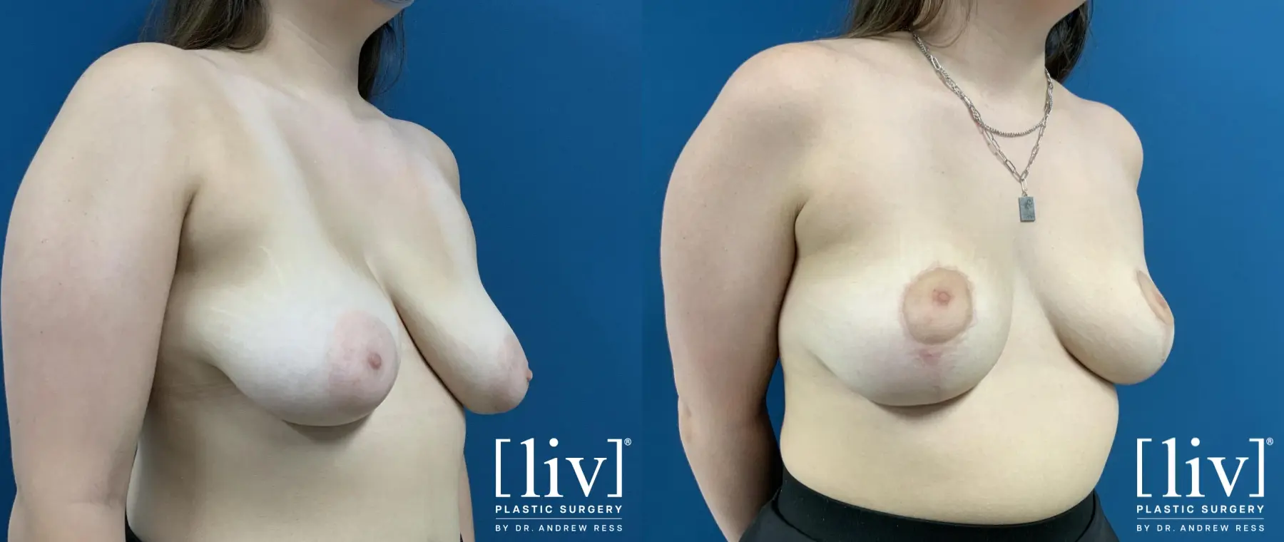 Breast Lift: Patient 3 - Before and After 4