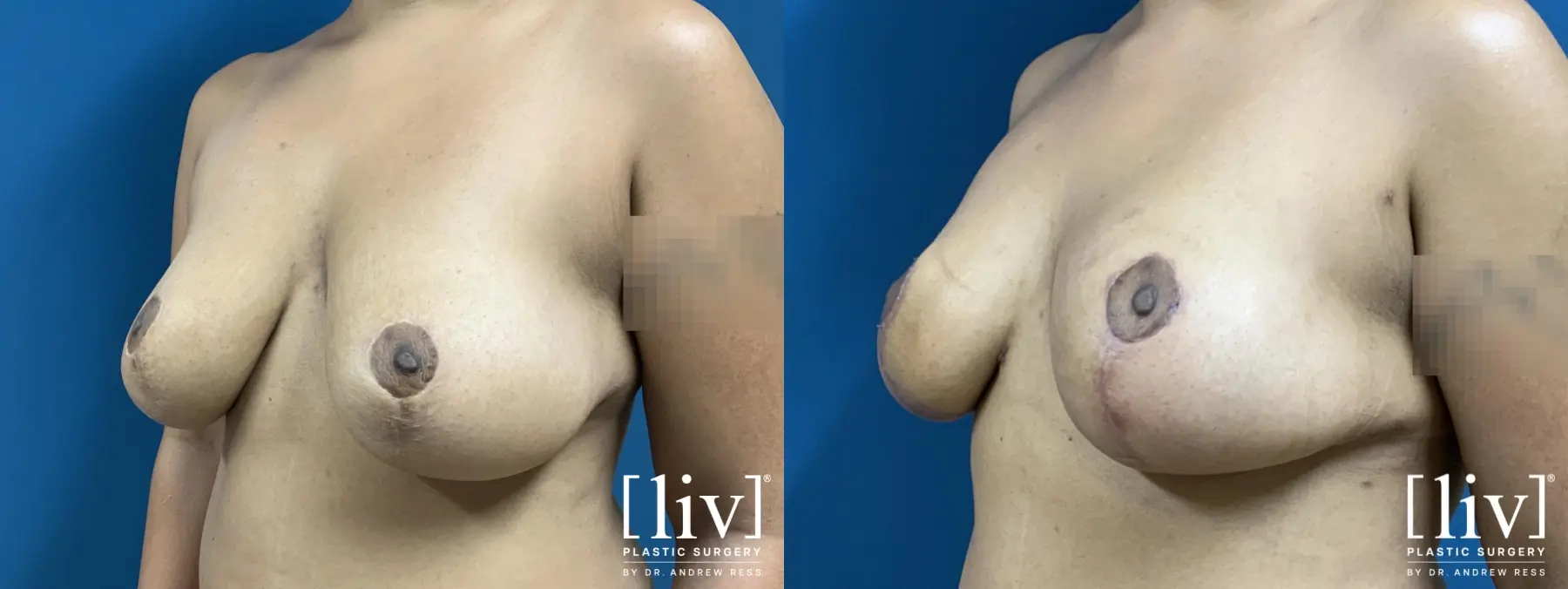 Breast Lift - Before and After 2