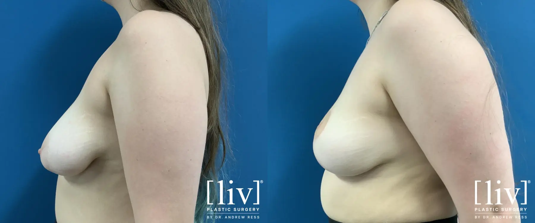 Breast Lift: Patient 3 - Before and After 3