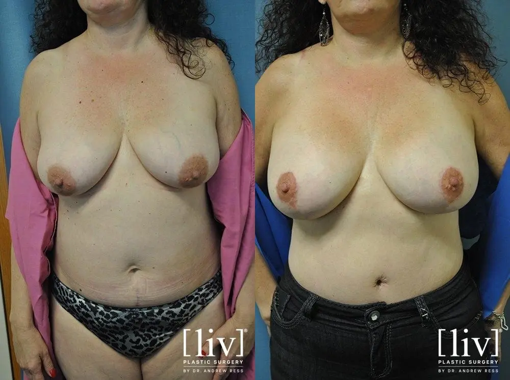 Breast Lift: Patient 6 - Before and After 1