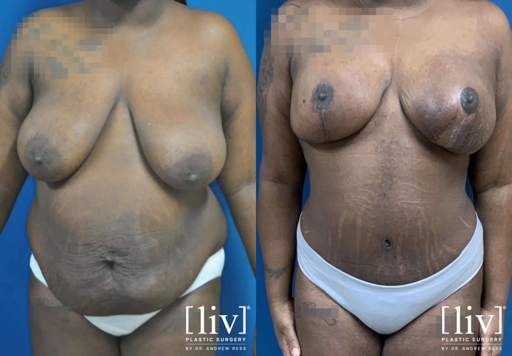 Breast Lift and Reduction - Before and After 1