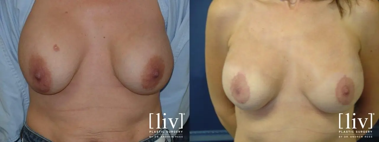 Breast Lift: Patient 7 - Before and After 1